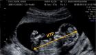 Ekzaminimi i parë gjatë shtatzënisë: kur dhe si të bëhet, interpretimi i rezultateve, normat dhe devijimet