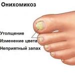 Онихомикоза - какво е това заболяване, причини, патоген, прояви по ръцете и краката и схеми на лечение