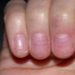 Cosa significano le macchie bianche sulle unghie?