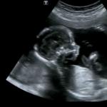 Posizione e presentazione del feto