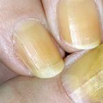 Onychomycosis of nails, drug treatment