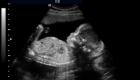 Ultrazvukové chyby pri určovaní pohlavia dieťaťa
