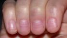 Τι σημαίνουν οι λευκές κηλίδες στα νύχια σας;